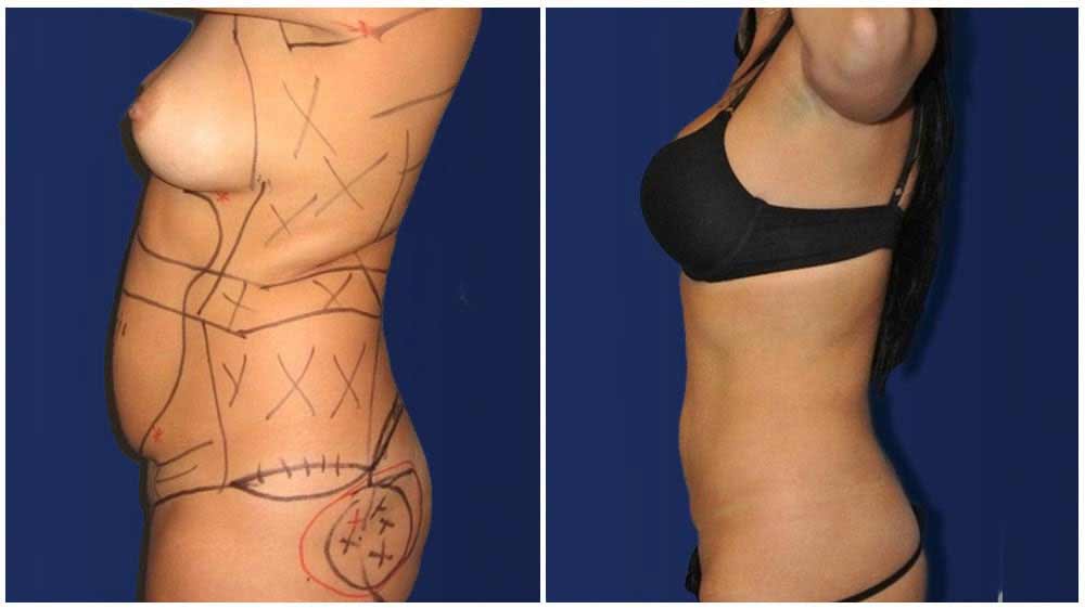 Fat Transfer of a Pittsburgh Liposuction Specialty Clinic Female Patient - (30 years)