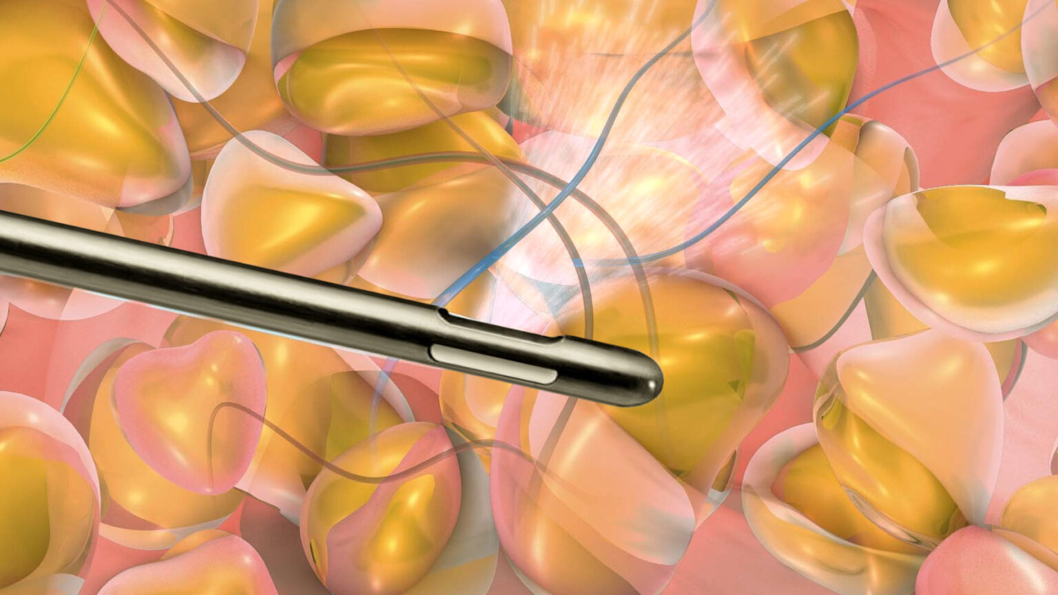 WaterLipo® (WaterJet Assisted Liposuction) Pittsburgh Liposuction